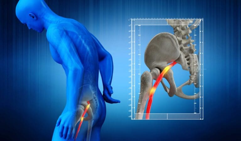 Sciatica Relief: 5 Proven Techniques for Opening Solace